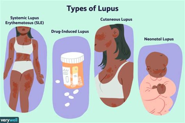 Pin on Lupus